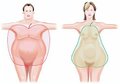 Зміни ліпідного обміну у хворих на ревматоїдний артрит із супутньою артеріальною гіпертензією, абдомінальним ожирінням та цукровим діабетом типу 2 залежно від поліморфізму гена T-786С ендотеліальної оксиду азоту синтази