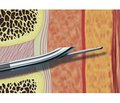 Experience in the use of various methods of combined spinal epidural anesthesia in reconstructive surgeries on the arteries of the lower extremities