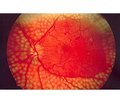 Вплив поліморфізмів rs2010963 і rs699947 гена VEGFА на клінічні та лабораторні показники при діабетичній ретинопатії у хворих на цукровий діабет 2-го типу