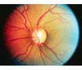 Correlation of rs35934224 polymorphism of TXNRD2 gene with primary open-angle glaucoma