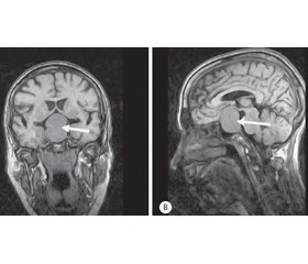 Neuro-ophthalmological aspects of large and giant pituitary adenomas