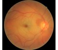 Retinal vascular occlusion after cardiac surgery: 6 months of observation