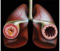 Якість життя хворих на бронхіальну астму, поєднану з ожирінням, з урахуванням виявлення поліморфізму RS9939609 гена FTO і RS324011 гена STAT6