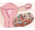 Частота и особенности течения субклинического синдрома Кушинга у женщин с синдромом поликистозных яичников
