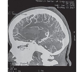 Клінічний випадок геморагічного інсульту у вагітної внаслідок розриву церебральної артеріовенозної мальформації