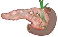 Особливості вуглеводного обміну у хворих на хронічне обструктивне захворювання легень за коморбідного перебігу хронічного панкреатиту