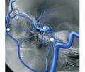Clinical case of endovascular embolization of dural carotid cavernous fistula by transvenous transorbital access