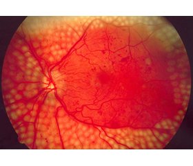 Effects of vitreoretinal operations on clinical picture of diabetic maculopathy in patients with type 2 diabetes mellitus