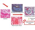 Scleroderma renal crisis: pathogenesis issues, disease pattern and modern approaches to the treatment