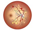 Модель прогнозування тяжкості діабетичної ретинопатії, отримана на основі ендотеліальної дисфункції та маркерів гіпоксії
