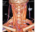 Неповоротний гортанний нерв, обумовлений аномальним ходом правої підключичної артерії (arteria lusoria), у пацієнтки з рецидивуючим папілярним тиреоїдним раком: перший в Україні документований клінічний випадок