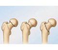 Сучасний стан лікування перипротезних переломів стегнової кістки
