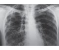 Синдром исчезающего легкого при туберкулезе