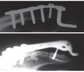 Analysis of long-term results of surgical treatment of acromioclavicular dislocation