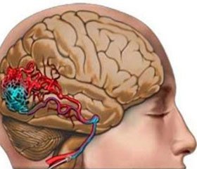 Эпилептический синдром и генерализованные мальформации головного мозга