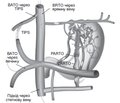 Трансвенозна облітерація варикозно розширених вен шлунка