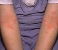 Случай атопического дерматита у ребенка   с панкреатической недостаточностью  