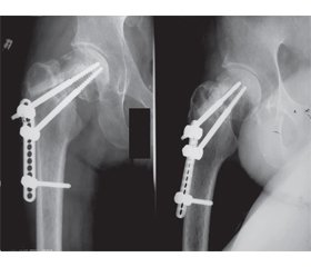 Реостеосинтез при псевдоартрозі шийки стегнової кістки
