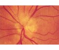 Citicoline in ophthalmologic practice: neuroprotection in ischemic optic neuropathy, diabetic retinopathy and amblyopia