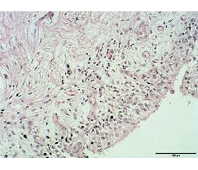 Морфологічні особливості синовіальної оболонки при травматичних ушкодженнях колінного суглоба у пацієнтів із метаболічними порушеннями