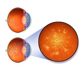 Is it possible to slow down the development of diabetic retinopathy? Options of non-invasive therapy for diabetic retinopathy in type 2 diabetes mellitus