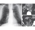 The role of clinical models in understanding the etiology of pneumonia