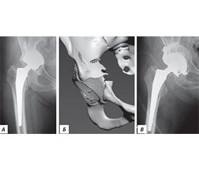 Наш досвід ревізійного ендопротезування кульшового суглоба