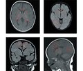 Clinical case of manifestation of tuberous sclerosis in a child