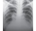 Дифференциальная диагностика двусторонней пневмонии с туберкулезом легких
