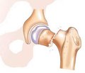Предоперационная распространенность тромбоза вен нижних конечностей у больных с переломами шейки бедренной кости