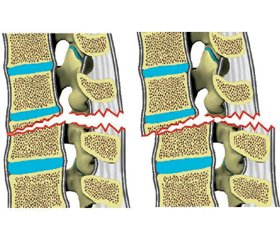 Можливості AOSpine Thoracolumbar Spine Injury Classification System у визначенні тактики лікування травматичних ушкоджень грудопоперекового переходу (огляд літератури)