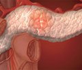 Патология поджелудочной железы, первичная и вторичная панкреатическая недостаточность при заболеваниях кишечника